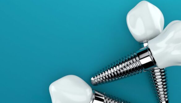 ¿Qué hacer si un implante dental se afloja?