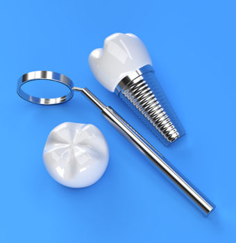 Falsos mitos de los implantes dentales