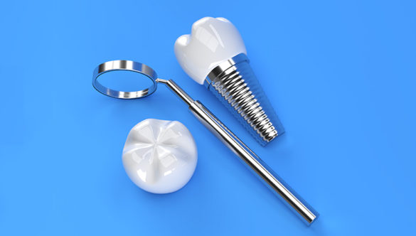 Falsos mitos de los implantes dentales