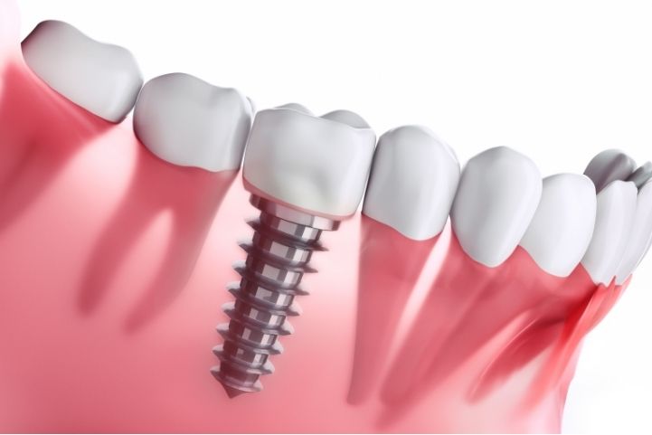 osteointegración