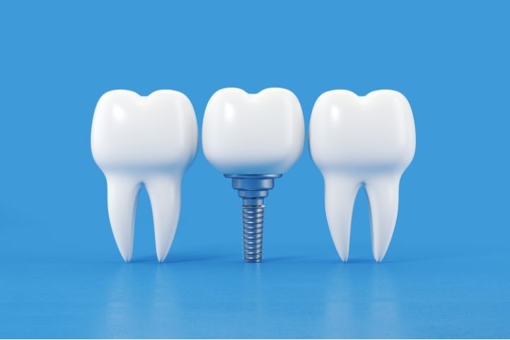 Osteointegración ¿Qué es?
