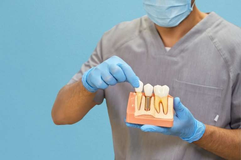 Cómo cuidar tus implantes dentales para mantener una sonrisa sana y duradera