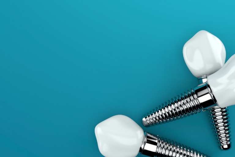 Implantes dentales 