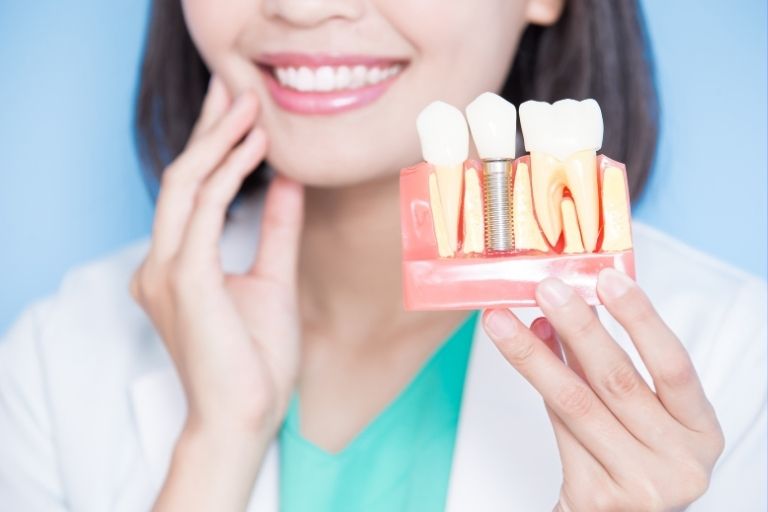 Dieta tras un implante dental 