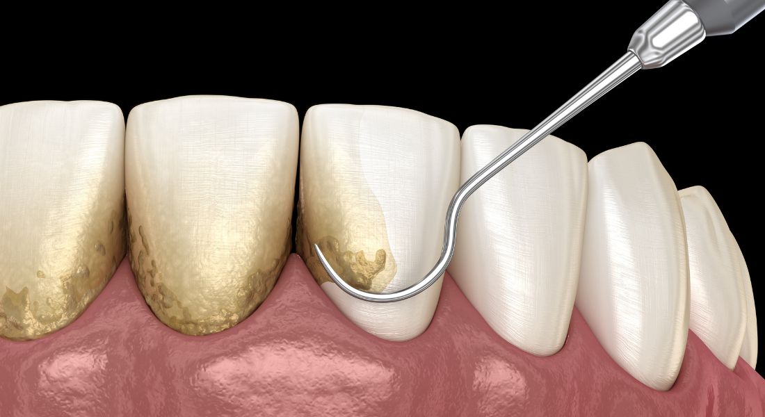 Periodontitis y la pérdida de dientes - Join Dental - Dentista Oviedo