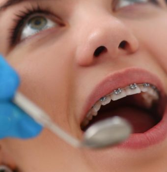 ¿Cuánto dura un tratamiento de ortodoncia?