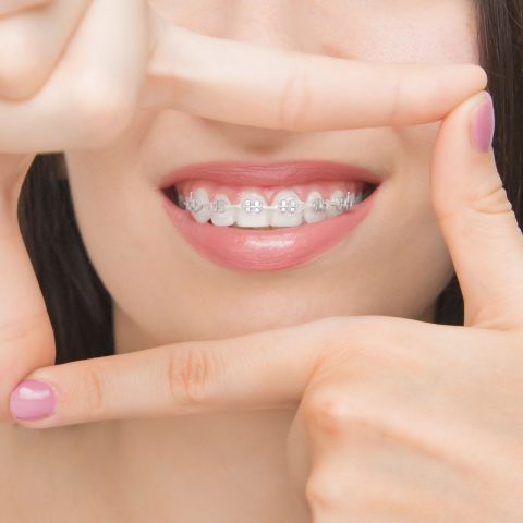 Dental braces in happy womans mouths through the frame. Brackets on the teeth after whitening. Self-ligating brackets with metal ties and gray elastics or rubber bands for perfect smile. Orthodontic teeth treatment.