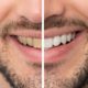 Causas y tratamiento de los dientes grises