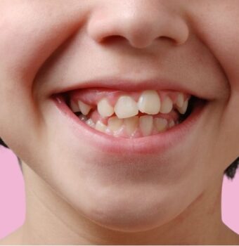 ¿Cómo tratar el apiñamiento dental?